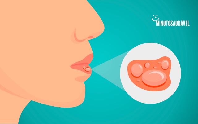 Foto de capa do artigo "Herpes labial: como tratar (remédio e pomada)? Veja sintomas"