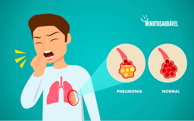 Foto de capa do artigo "Pneumonia: é contagiosa? Veja sintomas, tratamento, remédios"