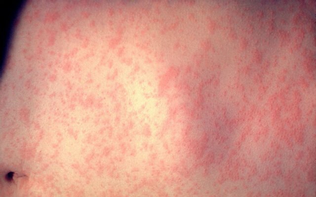 Sarampo O Que E Sintomas Tratamento Campanha De Vacinacao Ms