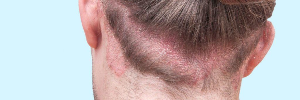 Foto de capa do artigo "Dermatite Seborreica: tem cura? Veja tratamento e remédios"