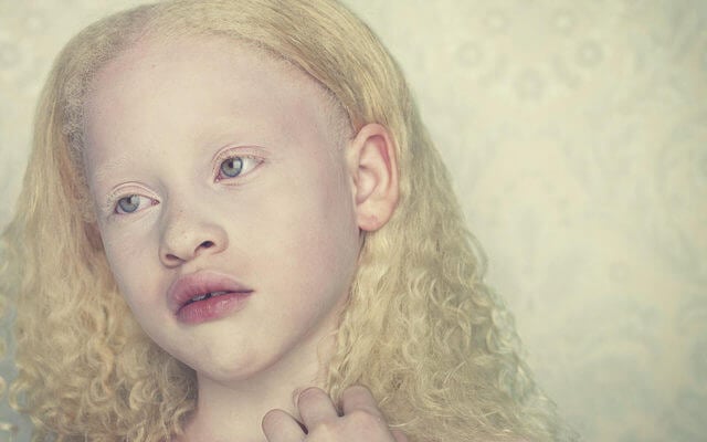Foto de capa do artigo "O que é Albinismo? Veja tipos, sintomas, características e +"