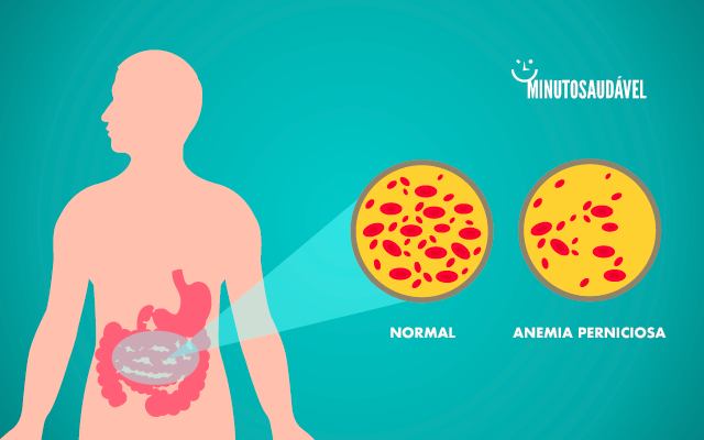 Foto de capa do artigo "Anemia Perniciosa: o que é, sintomas, causas e tratamento"