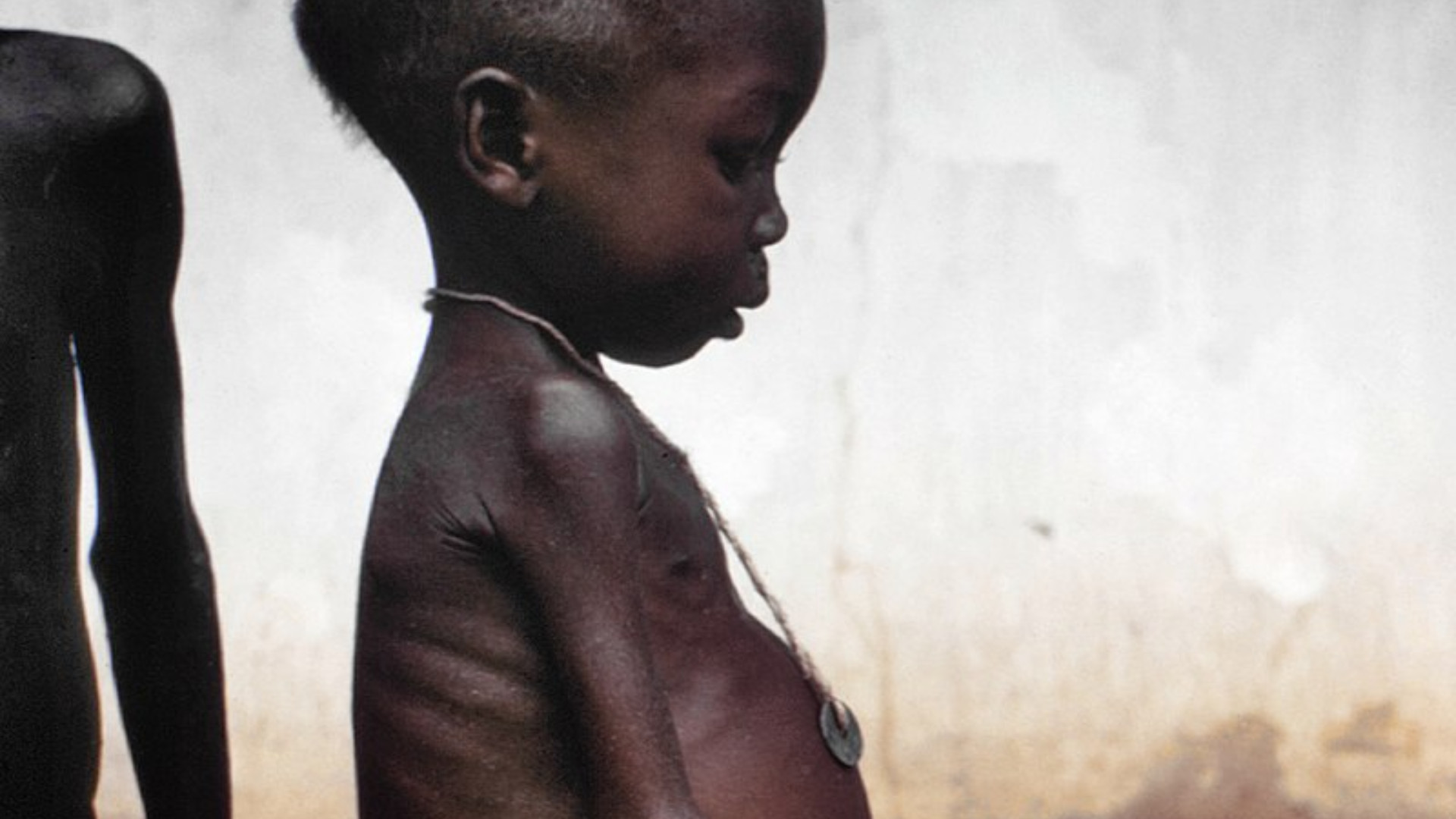 Foto de capa do artigo "Desnutrição infantil: como prevenir e tratar?"