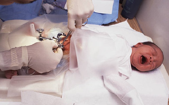 Circuncisão sendo realizada em um bebê por um cirurgião.