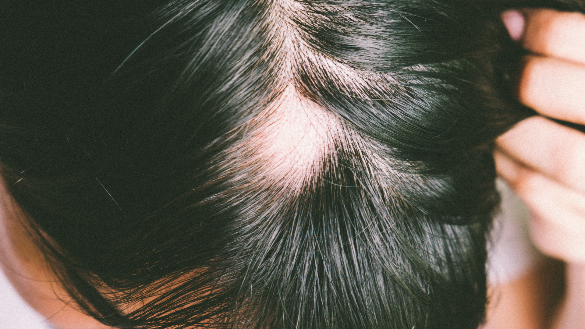 Foto de capa do artigo "Covid-19 e queda de cabelo: por que ocorre? Tem tratamento?"